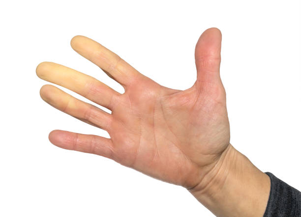 Hand with Raynaud's syndrome, Raynaud's phenomenon or Raynaud's diseases. stock photo