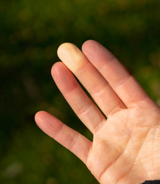 doigts atteints du syndrome de raynaud ou des maladies de raynauds. - discolored photos et images de collection