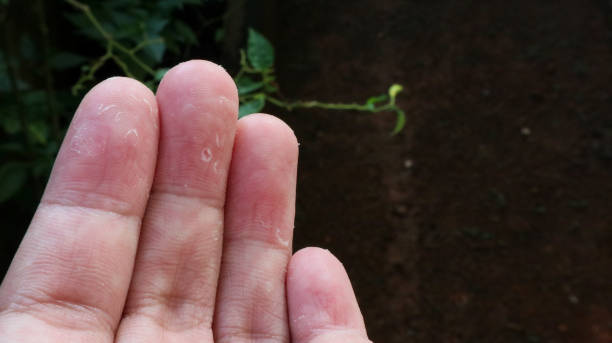 istock Peeling skin on hand and fingers. Desquamation 1356076440