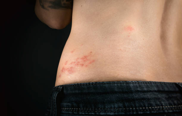 Shingles outbreak on torso of woman. The varicella-zoster virus has formed a red rash with fluid-filled blisters on the lower back (shingles belt) shingles rash stock pictures, royalty-free photos & images