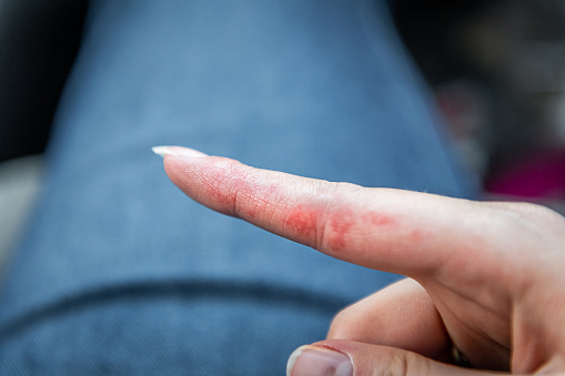 Macro closeup of red patches on index finger skin of female young woman's hand showing eczema medical condition called dyshidrotic pompholyx or vesicular dyshidrosis