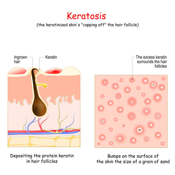 кератоз. кожные заболевания - bumpy stock illustrations