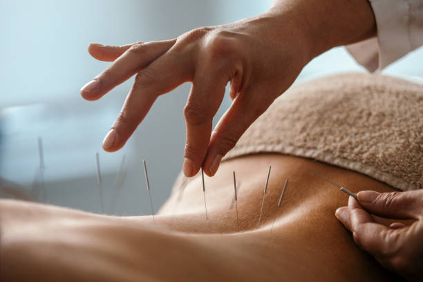 acupuncture back treatment - acupuncturist imagens e fotografias de stock