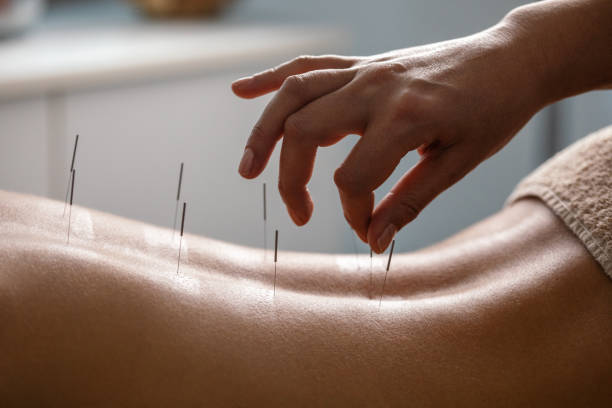 Acupuncture back treatment Acupuncture specialist inserting needle into patient's back due treatment. She is stimulating energy flow through the body for faster relaxation and recovery. acupuncture photos stock pictures, royalty-free photos & images