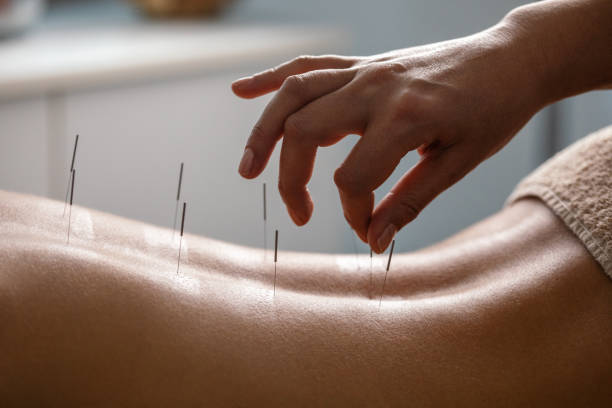 acupuncture back treatment - acupuncturist imagens e fotografias de stock