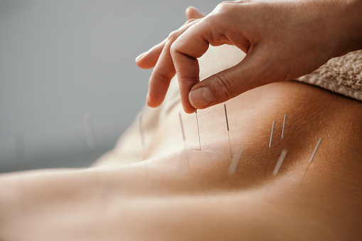 Acupuncture specialist inserting needle into patient's back due treatment. She is stimulating energy flow through the body for faster relaxation and recovery.