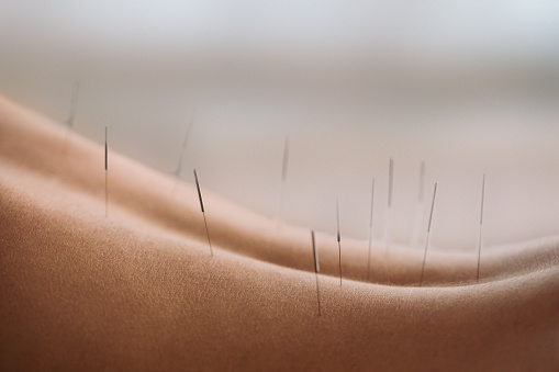 Acupuncture treatment with needles inserted into patient's back due treatment. She is getting stimulation for energy flow through the body for faster relaxation and recovery. Abstract photo of body part