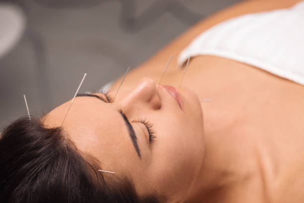 istock Acupuncture face treatment 1356339786