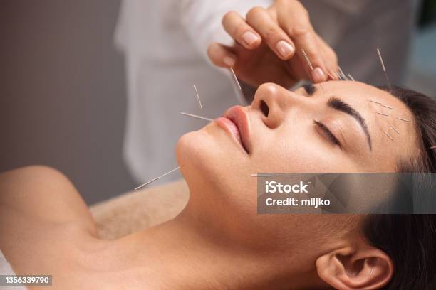 Acupuncture Face Treatment Stock Photo - Download Image Now - Acupuncture, Acupuncturist, Human Face