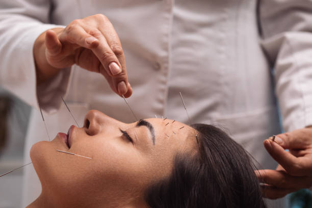 acupuncture traitement du visage - acupuncturist photos et images de collection