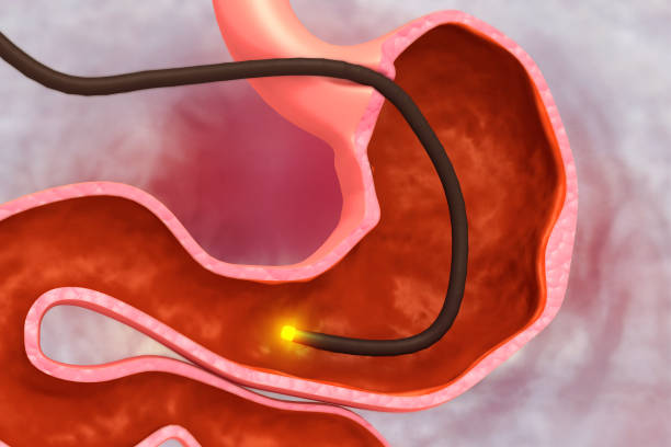 istock stomach Endoscopy.Gastric Balloon Inside a Stomach.3d illustration 1356347082