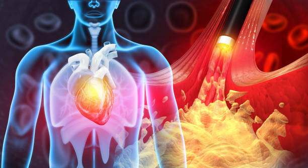 artère obstruée et maladie de l’athérosclérose. artère bloquée par le cholestérol. angioplastie du stent.3d illustration - angioplasty photos et images de collection