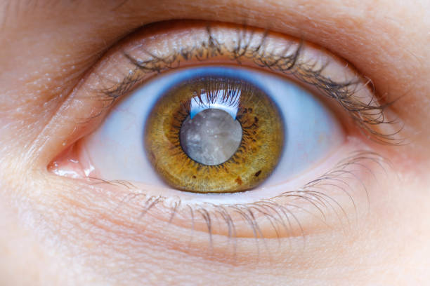 human eye with clouded lens, white pupil, cataract macro - lins ögonglob bildbanksfoton och bilder