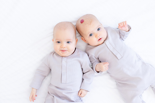 a little child with a hemangioma or a tumor on his head, two newborns, a twin baby, a girl in a cotton suit lying on a white bed at home and smiling