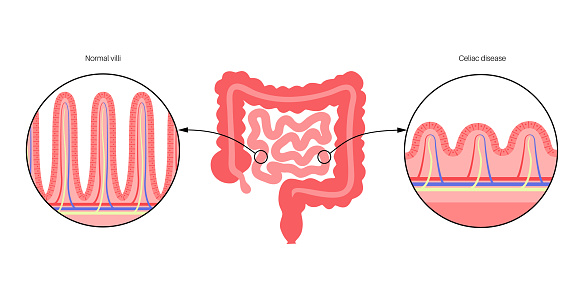 Celiac disease. Damaged and normal Intestinal villi in surface area of intestinal walls. Small intestine cross section, microvilli and epithelial cells. Digestive system medical vector illustration