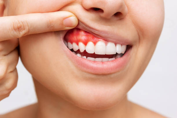 gum inflammation. cropped shot of a young woman showing bleeding gums - dentist pain human teeth toothache imagens e fotografias de stock