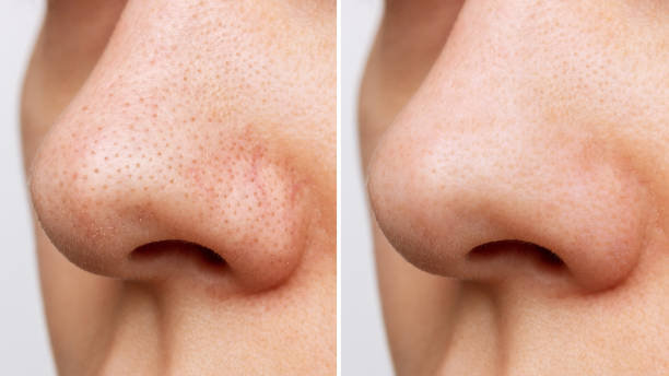 naso femminile con punti neri o punti neri prima e dopo il peeling e la pulizia del viso - pore foto e immagini stock