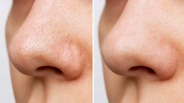 Close-up of woman's nose with blackheads or black dots before and after peeling and cleansing the face isolated on a white background. Acne problem, comedones. Cosmetology dermatology concept