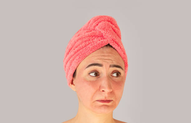 istock Face with skin irritation, problems, acne, rash or sunburn 1356801377