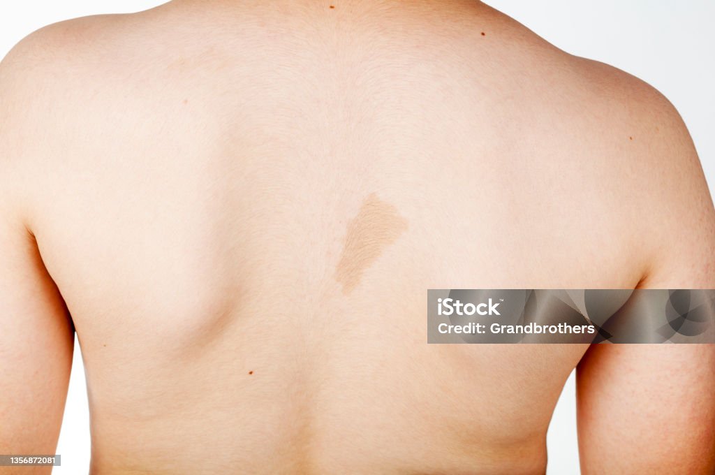 cafe au lait spot on the back of a caucasian boy A large light brown cafe au lait spot known as birth mark on the inter scapular region of a caucasian male. This benign skin discoloration may be related to a genetical disorder neurofibromatosis. Neurofibromatosis Stock Photo