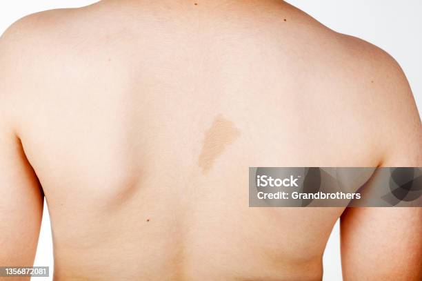 Cafe Au Lait Spot On The Back Of A Caucasian Boy Stock Photo - Download Image Now - Neurofibromatosis, Skin, Mole - Skin