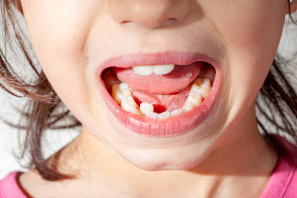 affollamento di denti permanenti appena scoppiati in una ragazza prima dell'intervento ortodontico - misalignment foto e immagini stock