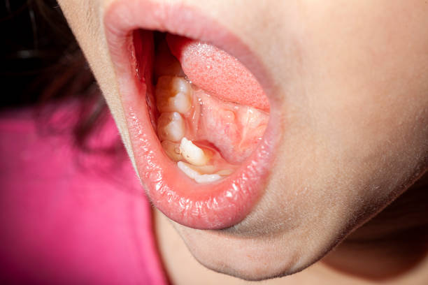istock crowding of newly errupted permanent teeth in a girl before orthodontic intervention 1356872087