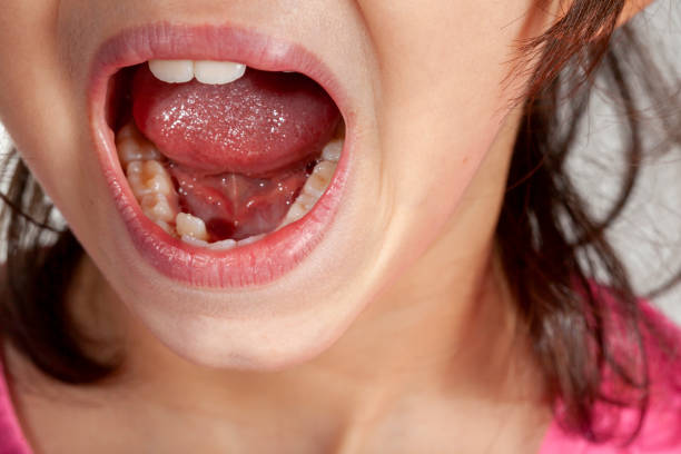 istock crowding of newly errupted permanent teeth in a girl before orthodontic intervention 1356872103