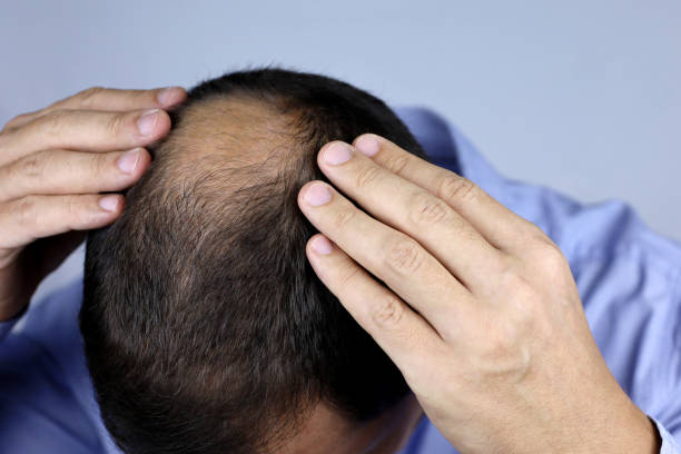 istock Baldness, man concerned about hair loss 1356948647