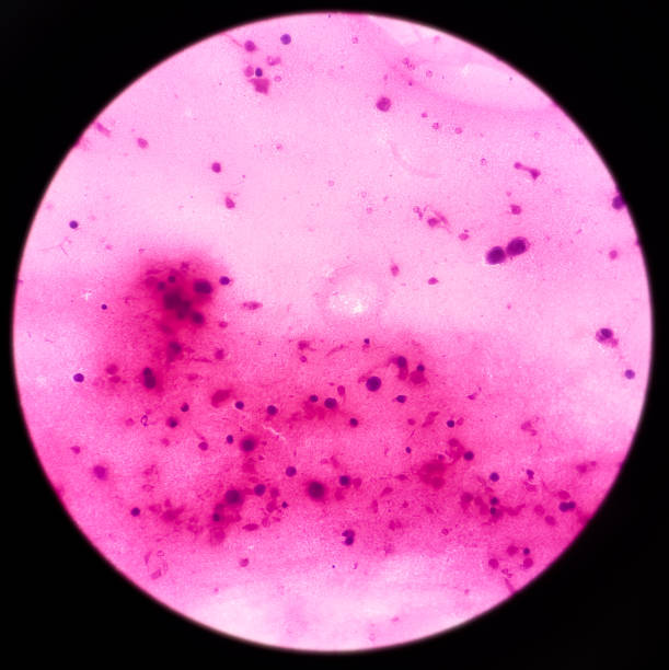 istock Inguinal lymph node, Malignant small round cell tumor, metastatic rhabdomyosarcoma(cancer of muscle) 1356983725