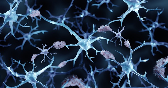 3d illustration showing amyloid plaques in Alzheimer's disease