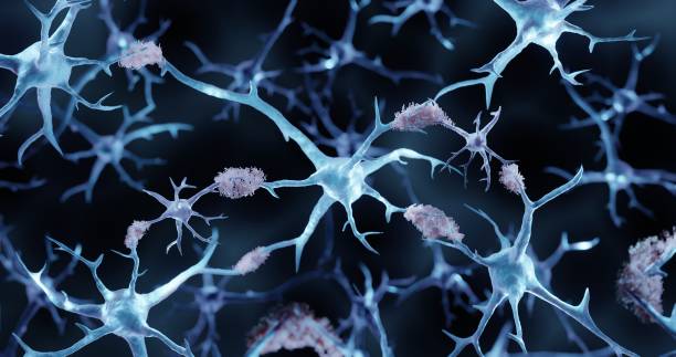 alzheimer's disease - amyloid bildbanksfoton och bilder