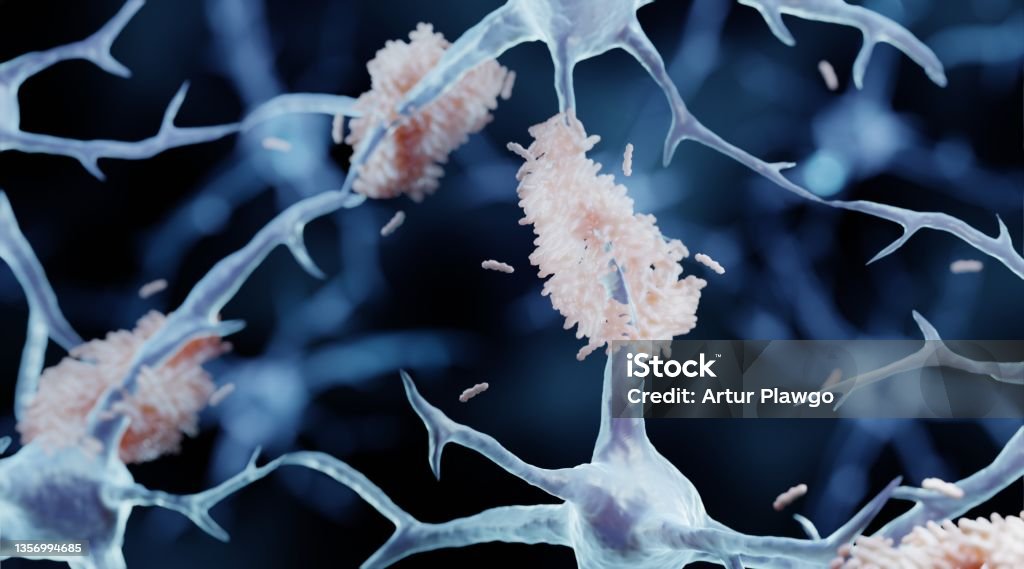 Amyloid plaques in Alzheimer's disease Amyloid plaques are misfolded proteins aggregates beetween neurons, Alzheimer's disease illustration Amyloid Stock Photo