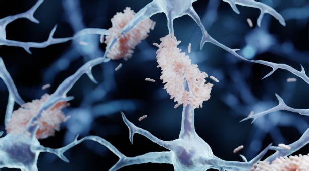 Amyloid plaques in Alzheimer's disease Amyloid plaques are misfolded proteins aggregates beetween neurons, Alzheimer's disease illustration alzheimer's disease stock pictures, royalty-free photos & images