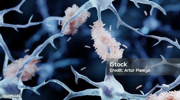 Amyloid Plaques In Alzheimers Disease Stock Photo - Download Image Now - Amyloid, Microglia, Alzheimer's Disease