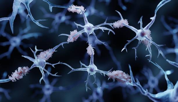 istock Amyloid plaques in Alzheimer's disease 1356994721