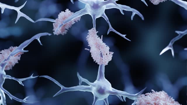 Amyloid plaques in Alzheimer's disease