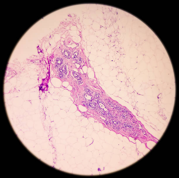 istock Breast biopsy, Microscopic image of breast tissue, fibrocystic changes(disease) 1357082251