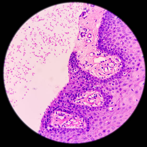 istock Buccal mucosa, Squamous hyperplasia, show hyperplastic squamous epithelium 1357082270