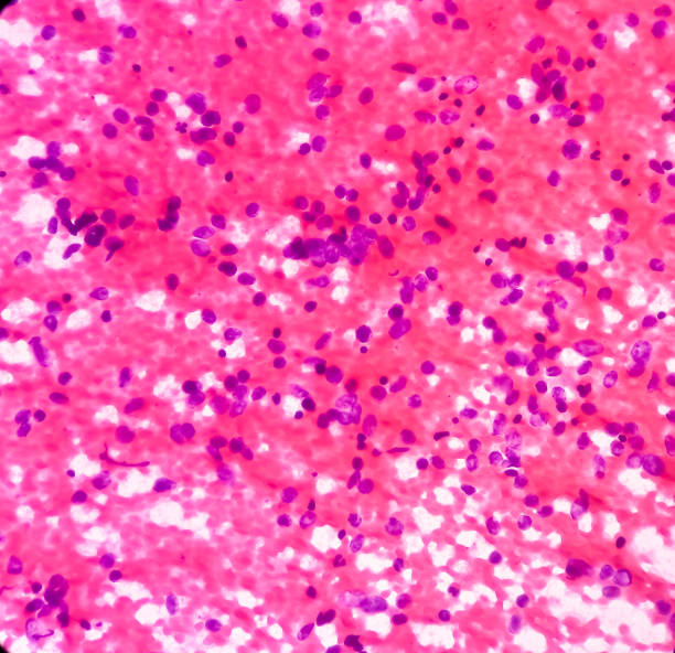 рак легких, фотомикрограф мелкоклеточного рака, злокачественные клетки, образец сапирата из массы легких с помощью кт-управляемой fna - cancer cell flash стоковые фото и изображения