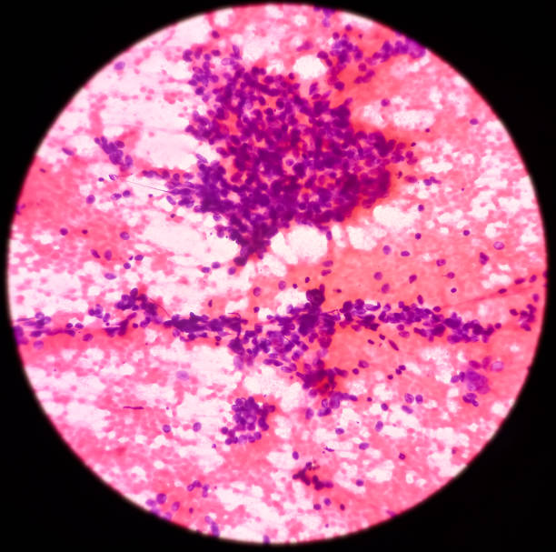 рак легких, фотомикрограф мелкоклеточного рака, злокачественные клетки, образец сапирата из массы легких с помощью кт-управляемой fna - cancer cell flash стоковые фото и изображения