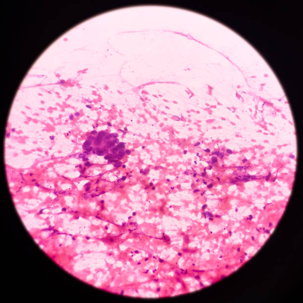 istock Squamous cell carcinoma of lung, malignant cells, sample aspirate from lung mass by CT guided FNA 1357243762