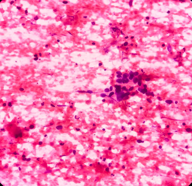 istock Squamous cell carcinoma of lung, malignant cells, sample aspirate from lung mass by CT guided FNA 1357243764