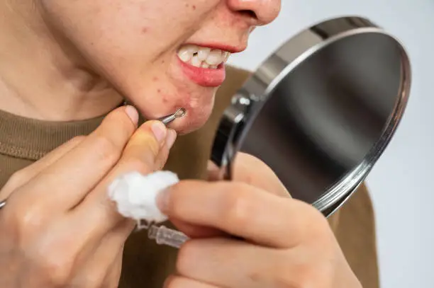 Photo of Close up of Asian woman trying to squeezing acne by using double headed acne needle while looking mini mirror.