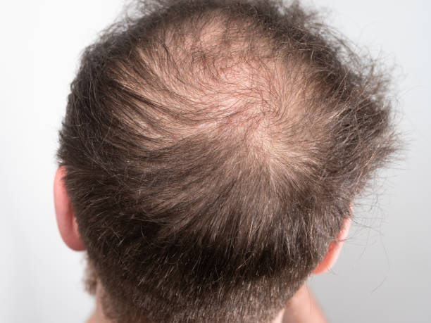 istock Balding Man Back of Head 1357275481