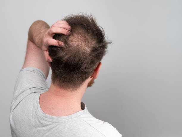 glatzköpfiger mann zeigt haarausfall an der krone seines kopfes - head in hands fotos stock-fotos und bilder