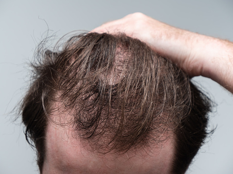Hombre calvo que muestra pérdida de cabello en la parte delantera de su cabeza photo