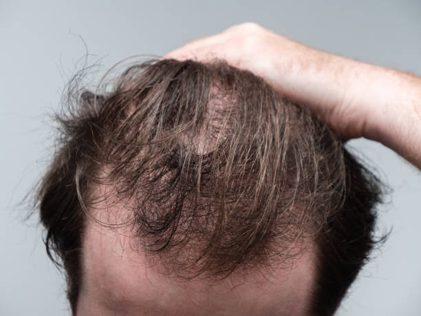 Balding Man showing hair loss at the front of his head Close up of a young man holding his hair back showing clear signs of a receding hairline and hair loss. First stages of male pattern baldness with bald patches and thinning hair. hair loss stock pictures, royalty-free photos & images