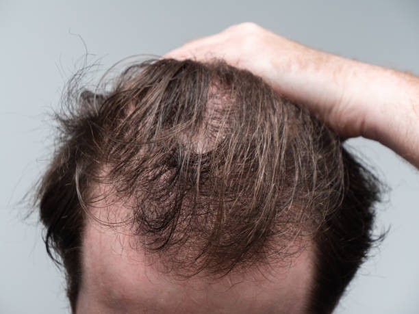 balding man showing hair loss at the front of his head - hair loss imagens e fotografias de stock