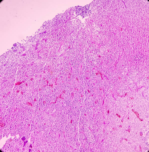 Olfactory neuroblastoma(ONB) or Esthesio neuroblastoma. Tissue from nasopharyngeal growth Olfactory neuroblastoma(ONB) or Esthesio neuroblastoma. Tissue from nasopharyngeal growth, light microscopic show malignant neoplasm. It's an uncommon malignant neuroectodermal nasal tumor. endothelial stock pictures, royalty-free photos & images